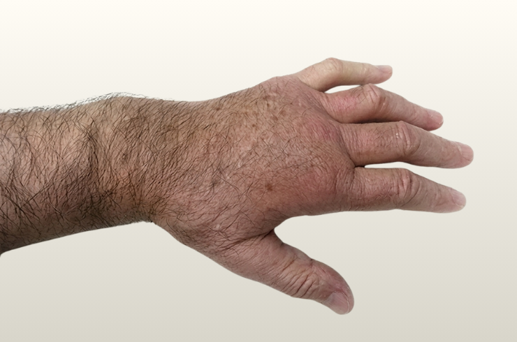 Complex regional pain syndrome