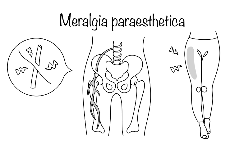 Meralgia paresthetica treatment