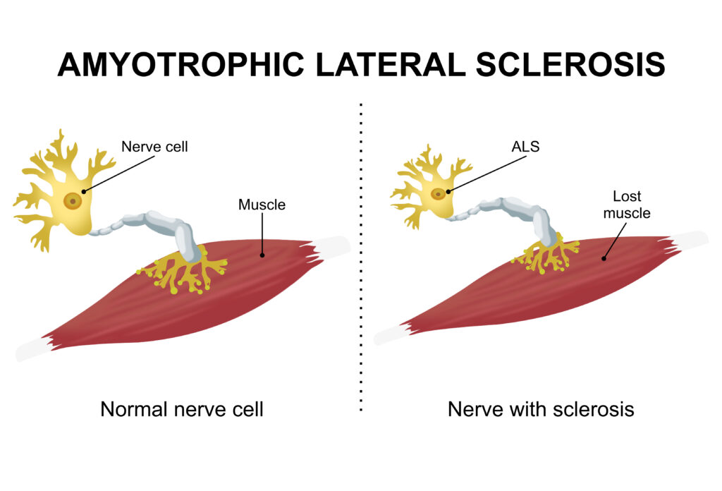 Amyotrophic Lateral Sclerosis